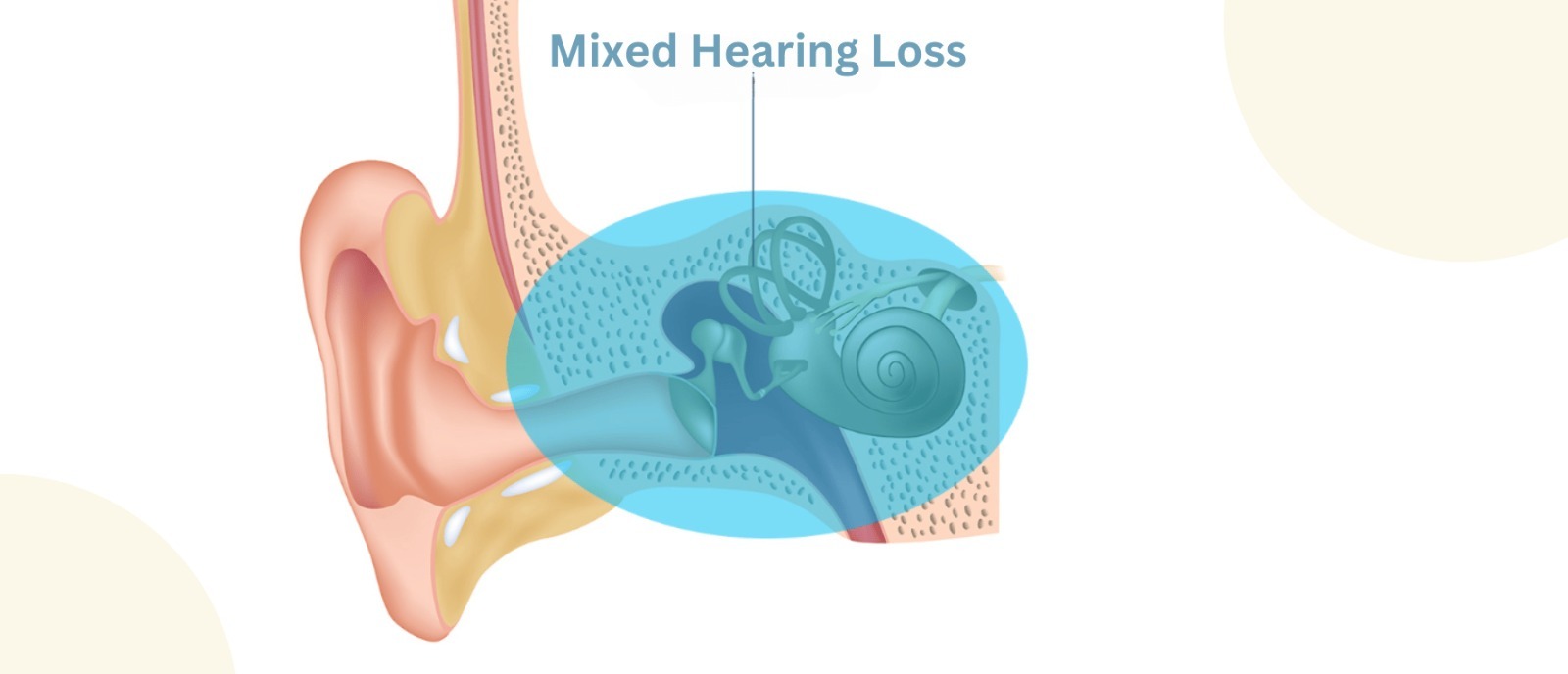 Are Hearing Aids the Only Solution for All Kinds Of Hearing Loss? | Aanvii Hearing